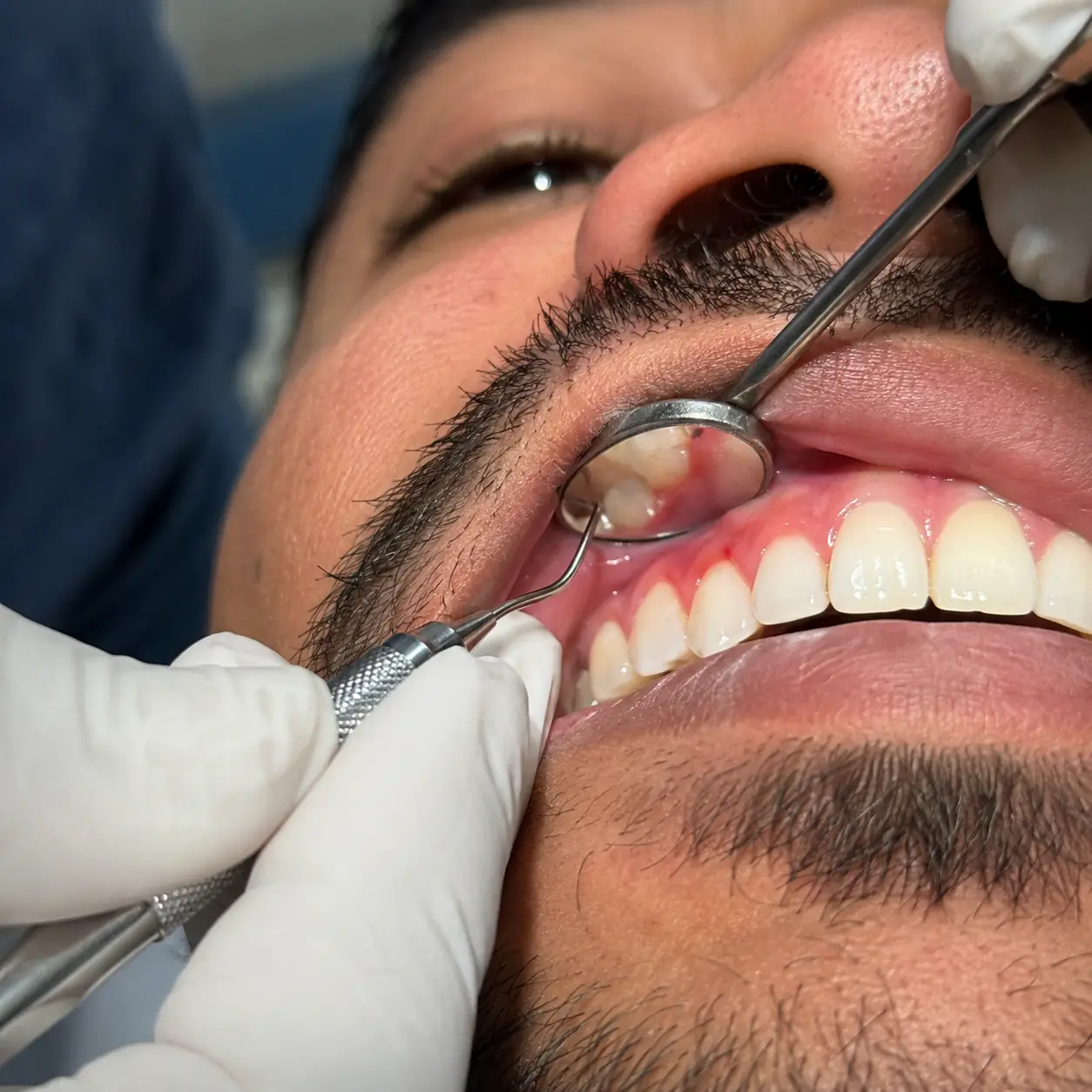 Avaliação odontológica de perto durante consulta na Zanette Odontologia em Botucatu