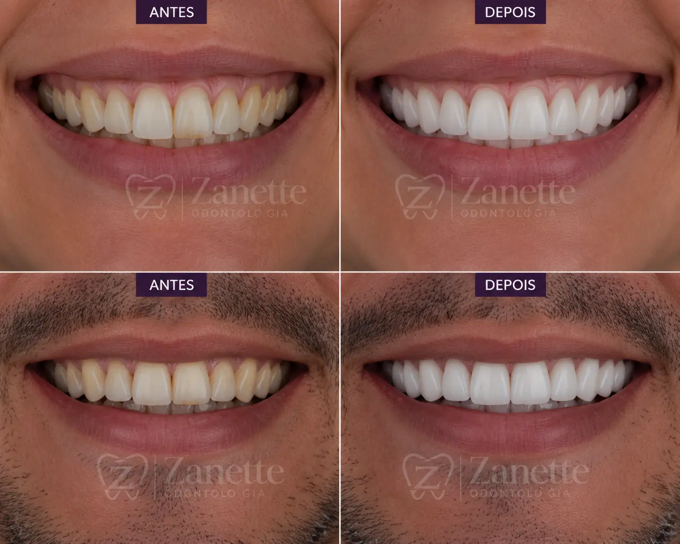 Comparação antes e depois de sorriso reabilitado com facetas na Zanette Odontologia em Botucatu