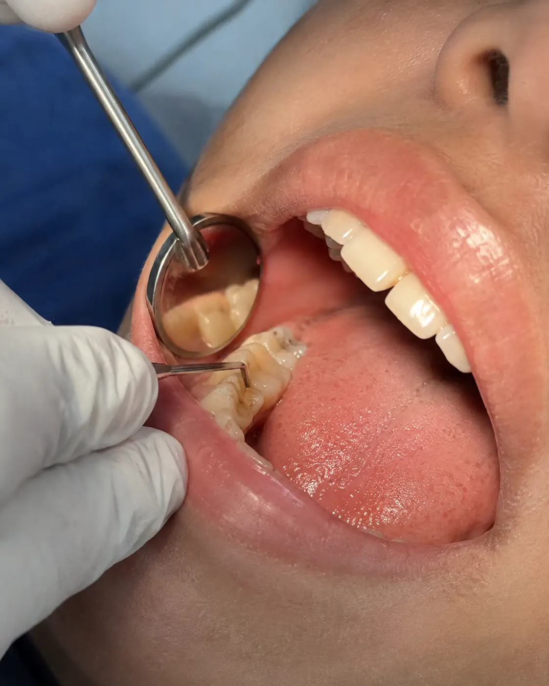 Exame com espelho odontológico durante limpeza e prevenção na Zanette Odontologia em Botucatu